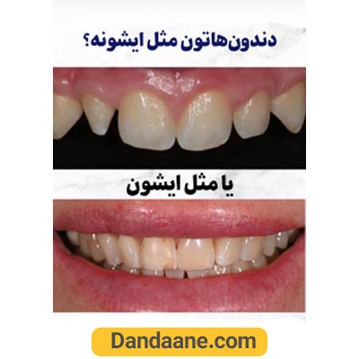 نمونه کار قبل لمینت دندان دکتر سعید میرزایی