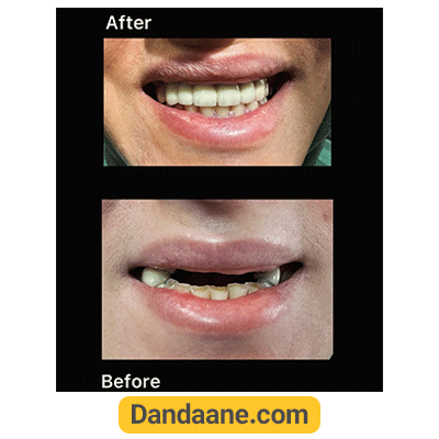 نمونه کار قبل و بعد ایمپلنت دندان دکتر ارمغان شماره 2