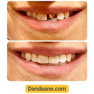نمونه کار قبل و بعد ایمپلنت دندان دکتر ارمغان شهبازی