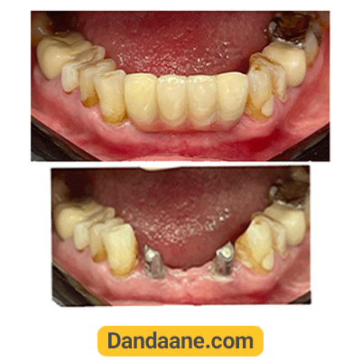 نمونه کار قبل و بعد ایمپلنت دکتر ارمغان شهربازی شماره 1