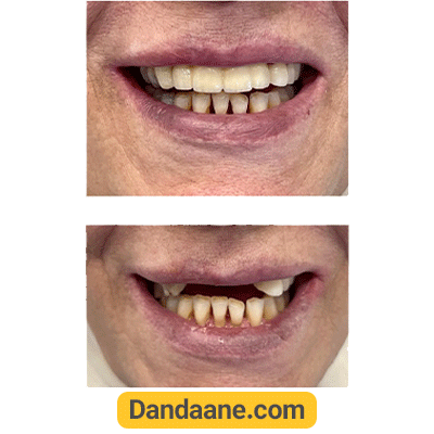 نمونه کار قبل و بعد ایمپلنت دکتر ارمغان شهربازی