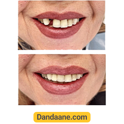 نمونه کار قبل و بعد دکتر ارمغان شهربازی