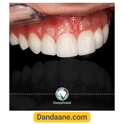 نمونه کار پروتز دندان کلینیک دندانپزشکی دنیا دنتال شماره 1