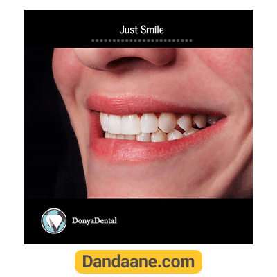 نمونه کار پروتز دندان کلینیک دندانپزشکی دنیا دنتال