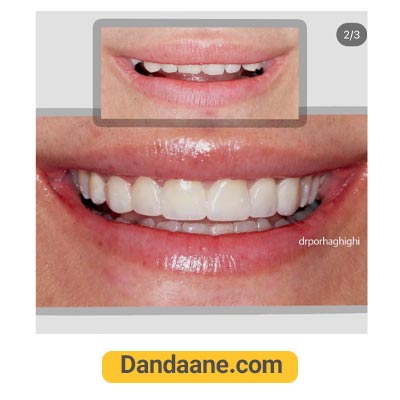 یک نمونه کار بعد لمینت دندان دکتر محسن پور حقیقی