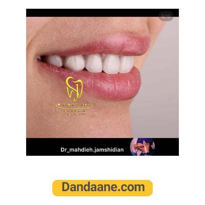 یک نمونه کار بعد لمینت دندان دکتر مهدیه جمشیدیان