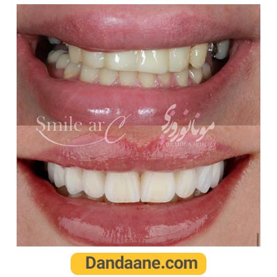 یک نمونه کار قبل و بعد لمینت دندان دکتر مونا نوروزی