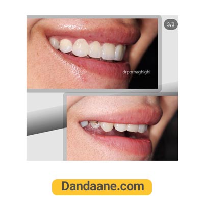 یک نمونه کار نصب لمینت توسط دکتر محسن پور حقیقی