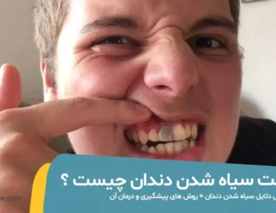 سیاه شدن دندان