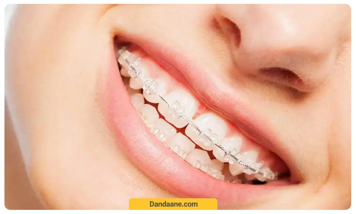 براکت های ارتودنسی سرامیکی، شفاف هستند و این تنها تفاوتشان با ارتودنسی معمولی است.