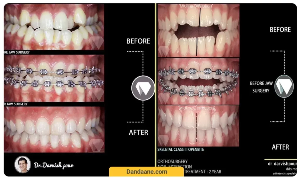 نمونه کار ارتودنسی ثابت 