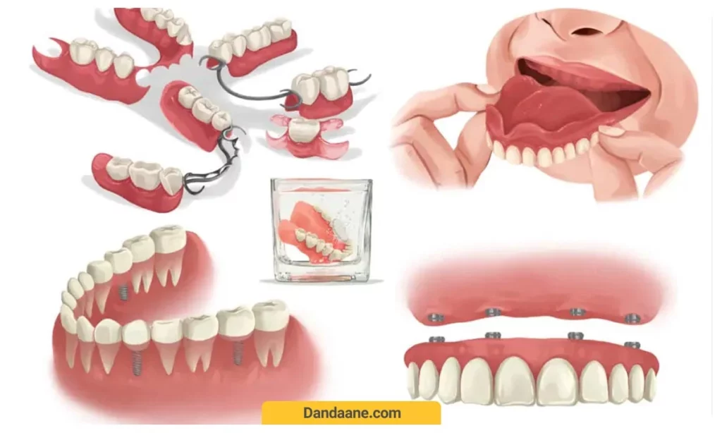 انواع دندان مصنوعی 