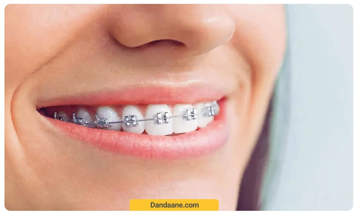 ارتودنسی ثابت فلزی رایج ترین و قدیمی ترین شکل ارتودنسی دندان است 