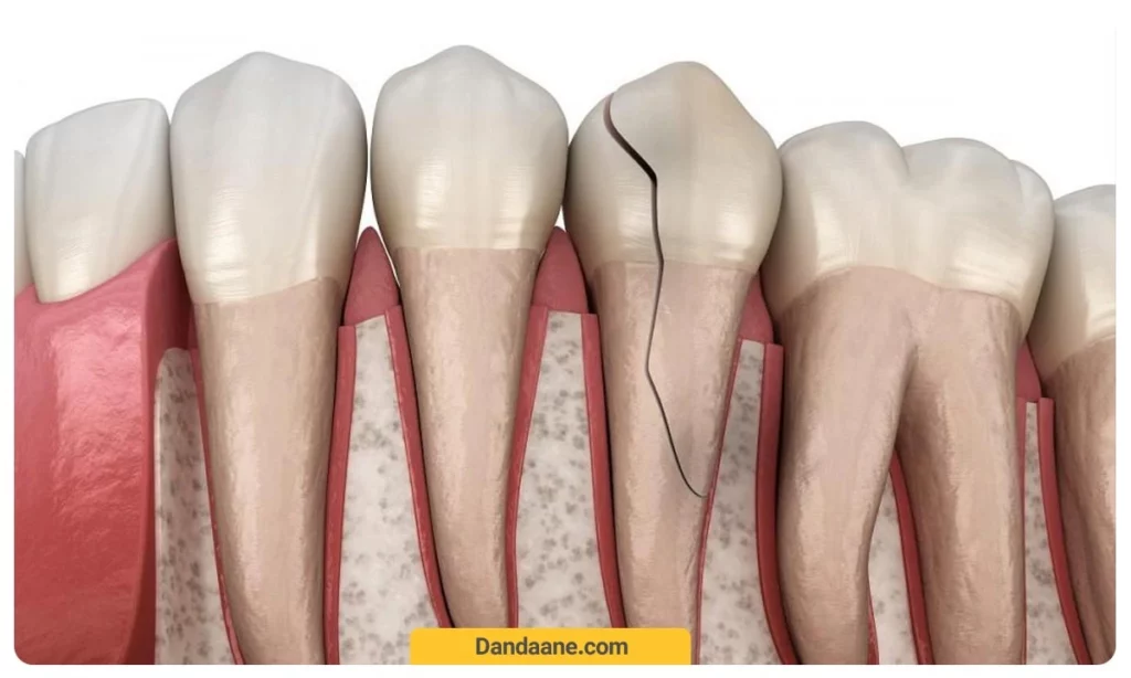 ترک های مویی دندان 