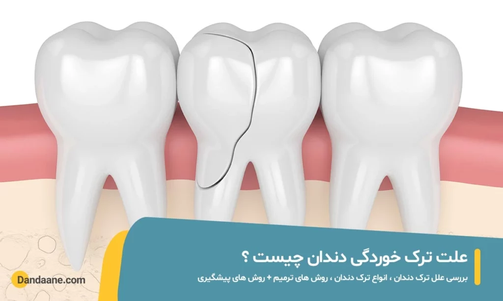 علت ترک خوردگی دندان چیست