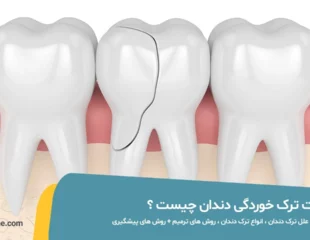 علت ترک خوردگی دندان چیست