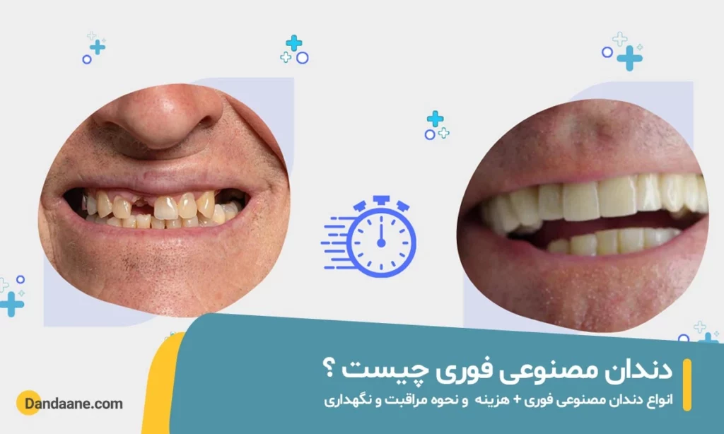 دندان مصنوعی فوری