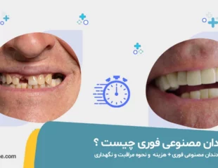 دندان مصنوعی فوری