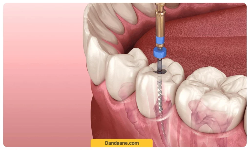 عصب کشی دندان 