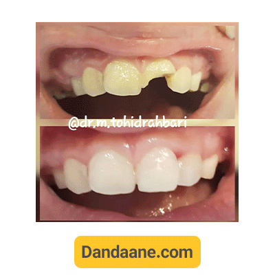 ترمیم شکستگی تاج دندان توسط دکتر منیره توحید رهبری