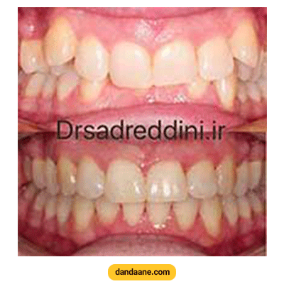 نمونه کار ارتودنسی دکتر فرهاد صدرالدینی شماره 2