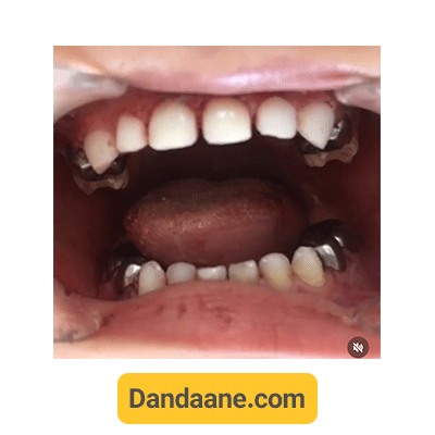 نمونه کار بعد دکتر نرجس امیری طهرانی زاده - شماره 1