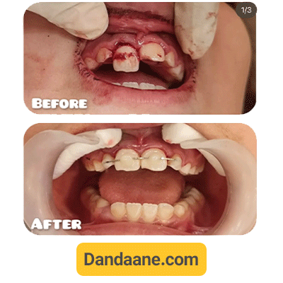 نمونه کار درمان ضربه وارد شده به دندان توسط دکتر مهسا منصوری