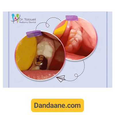 نمونه کار روکش دندان توسط دکتر آلاله طلوعی