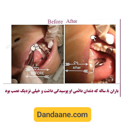 نمونه کار قبل و بعد نمونه کار دکتر هانیه درویش دماوندی - شماره 1