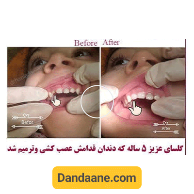 نمونه کار قبل و بعد نمونه کار دکتر هانیه درویش دماوندی - شماره 2