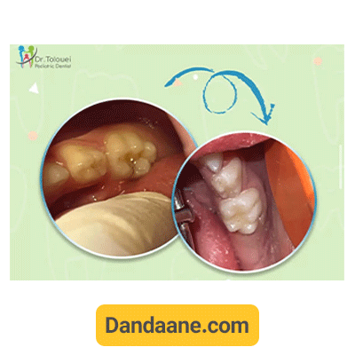 نمونه کار پر کرد دندان دکتر آلاله طلوعی