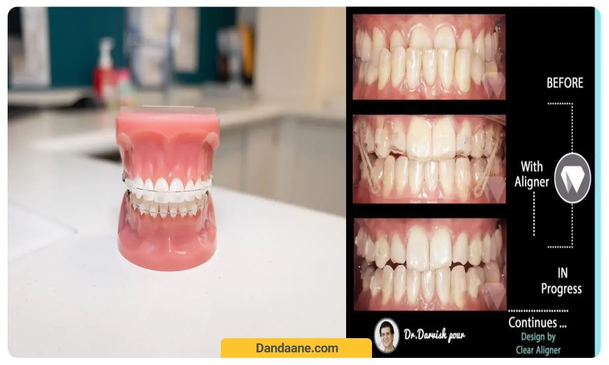 ارتودنسی سرامیکی 