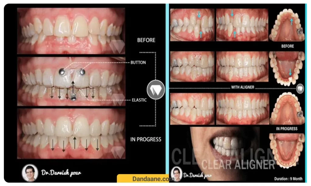 شدت مشکل بر هزینه ارتودنسی تاثیرگذار است