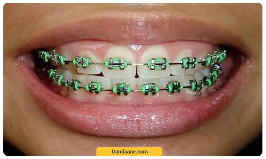 ارتودنسی سبز