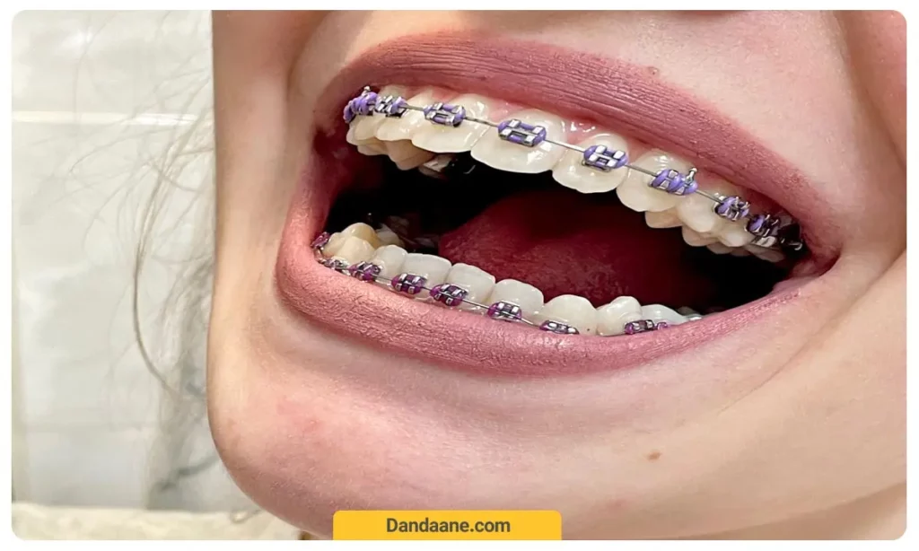 ارتودنسی بنفشی 