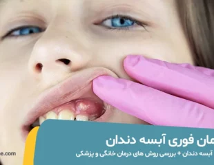 درمان فوری آبسه دندان