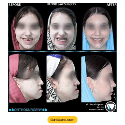 نمونه کار ارتودنسی با جراحی فک دکتر هادی درویش پور