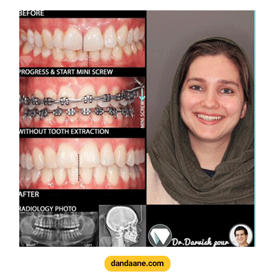 نمونه کار ارتودنسی ثابت دکتر هادی درویش پور
