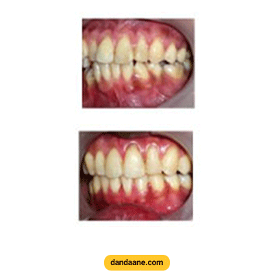 نمونه کار ارتودنسی دکتر هومن زرنگار