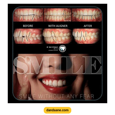 نمونه کار ارتودنسی نامرئی دکتر هادی درویش پور