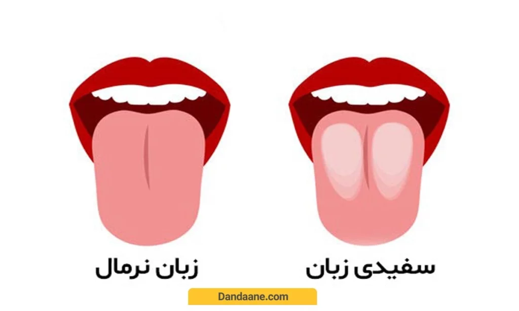 تفاوت زبان معمولی با سفیدی زبان 