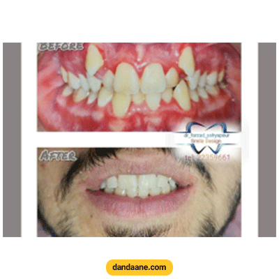 نمونه کار ارتودنسی به همراه کشیدن دندان دکتر فرزاد یحیی پور