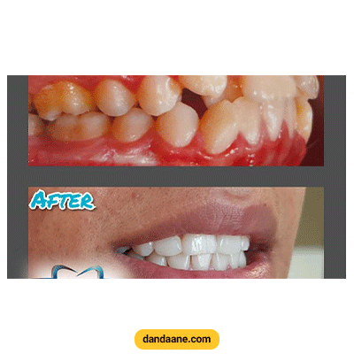 نمونه کار ارتودنسی به همراه کشیدن دندان دکتر فرزاد یحیی پور