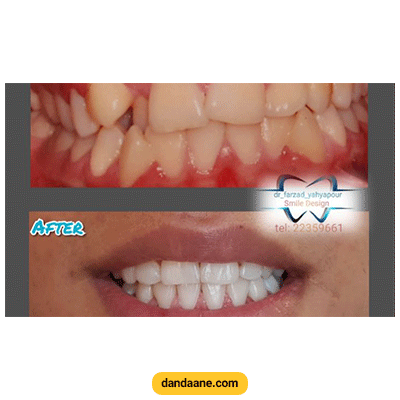 نمونه کار ارتودنسی به همراه کشیدن دندان دکتر فرزاد یحیی پور