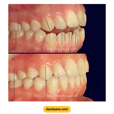 نمونه کار ارتودنسی دکتر زیبا مشایخی شماره 1