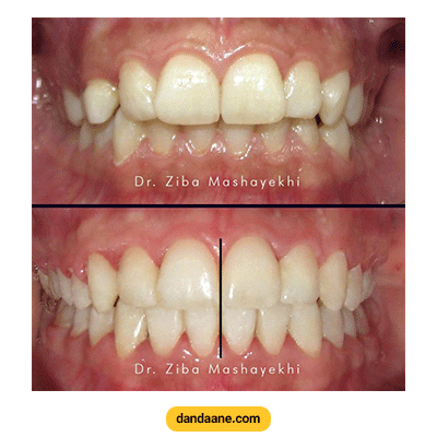 نمونه کار ارتودنسی دکتر زیبا مشایخی شماره 2