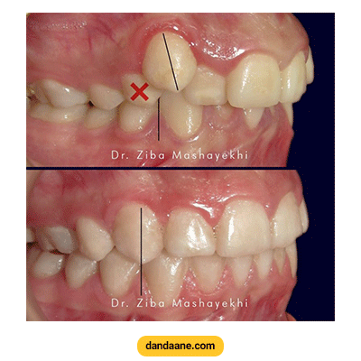 نمونه کار ارتودنسی دکتر زیبا مشایخی