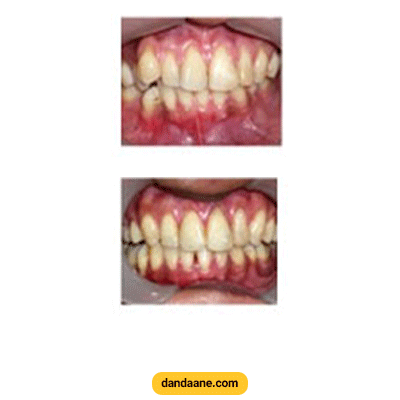 نمونه کار ارتودنسی دکتر هومن زرنگار شماره 1