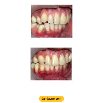 نمونه کار ارتودنسی دکتر هومن زرنگار شماره 2