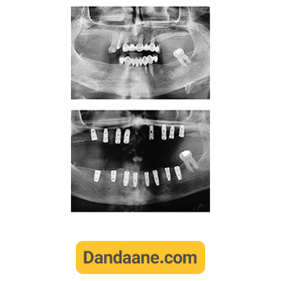 عکس او پی جی نمونه کار ایمپلنت دندان دکتر آرش غفوری
